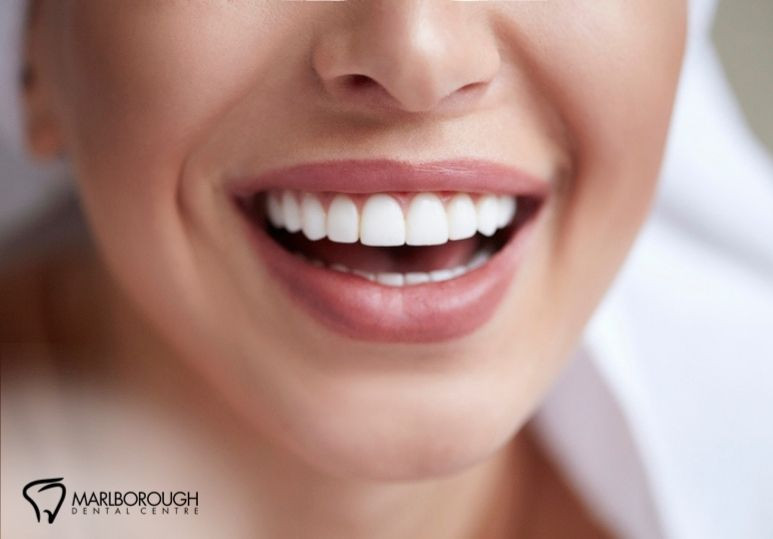 The Psychology of a Beautiful Smile: How Cosmetic Dentistry Can Boost Your Confidence 